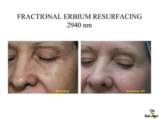 FRACTIONAL ERBIUM RESURFACING
2940 nm
Pre op Post op week 7
David Kent,
MD
David Kent, MD
 