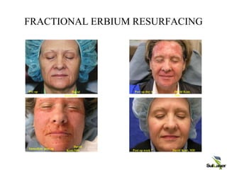 FRACTIONAL ERBIUM RESURFACING
Pre op
Immediate post op
Post op day 4
Post op week 7
David
Kent,MD
David Kent,
MD
David
Kent,MD David Kent, MD
 