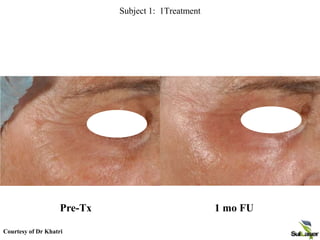 Palomar Medical Technologies Inc.
Confidential and Privileged
Subject 1: 1Treatment
Pre-Tx 1 mo FU
Courtesy of Dr Khatri
 