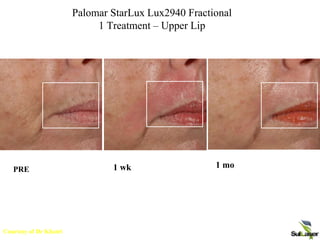 Palomar Medical Technologies Inc.
Confidential and Privileged
Palomar StarLux Lux2940 Fractional
1 Treatment – Upper Lip
PRE
1 mo
1 wk
Courtesy of Dr Khatri
 