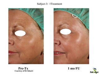 Palomar Medical Technologies Inc.
Confidential and Privileged
Subject 3: 1Treatment
Pre-Tx 1 mo FU
Courtesy of Dr Khatri
 