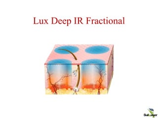 Lux Deep IR Fractional
 