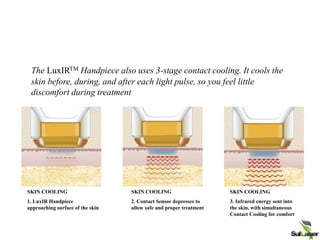 CONFIDENTIAL | ©
2008 Palomar Medical
SKIN COOLING
1. LuxIR Handpiece
approaching surface of the skin
SKIN COOLING
2. Contact Sensor depresses to
allow safe and proper treatment
SKIN COOLING
3. Infrared energy sent into
the skin, with simultaneous
Contact Cooling for comfort
The LuxIRTM Handpiece also uses 3-stage contact cooling. It cools the
skin before, during, and after each light pulse, so you feel little
discomfort during treatment
LuxDeepIR
™
Fractional
 