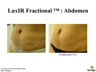 LuxIR Fractional ™ : Abdomen
6 weeks post TX 3
Courtesy of Christine Dierickx, MD
Boom, Belgium
 