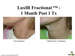 Courtesy of Kenneth Rothaus M.D.
Pre-Treatment 1 Month Post 1 Treatment
LuxIR Fractional ™ :
1 Month Post 1 Tx
 
