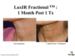 Courtesy of Kenneth Rothaus M.D.
Pre-Treatment 1 Month Post 1 Treatment
LuxIR Fractional ™ :
1 Month Post 1 Tx
 