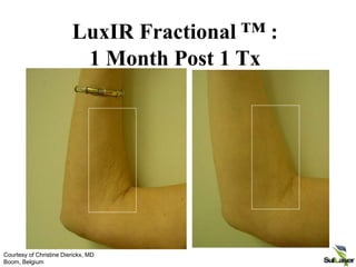 Pre 10 wk post Tx
LuxIR Fractional ™ :
1 Month Post 1 Tx
Courtesy of Christine Dierickx, MD
Boom, Belgium
 
