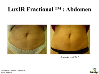 LuxIR Fractional ™ : Abdomen
6 weeks post TX 3
Courtesy of Christine Dierickx, MD
Boom, Belgium
 