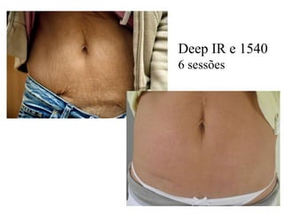 Deep IR e 1540
6 sessões
 