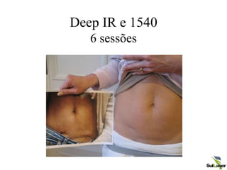 Deep IR e 1540
6 sessões
 