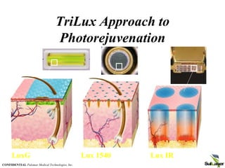 TriLux Approach to
Photorejuvenation
LuxG Lux 1540 Lux IR
CONFIDENTIAL Palomar Medical Technologies, Inc.
 