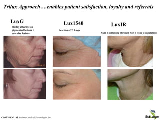 Trilux Approach….enables patient satisfaction, loyalty and referrals
.
Highly effective on
pigmented lesions +
vascular lesions Skin Tightening through Soft Tissue Coagulation
Fractional™ Laser
Lux1540
LuxG
LuxIR
CONFIDENTIAL Palomar Medical Technologies, Inc.
 