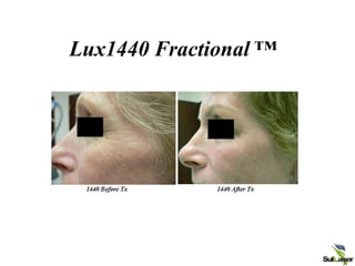 Lux1440 Fractional ™
 
