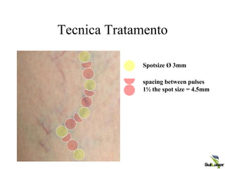 Tecnica Tratamento
Spotsize Ø 3mm
spacing between pulses
1½ the spot size = 4.5mm
 