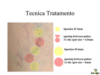 Tecnica Tratamento
Spotsize Ø 3mm
spacing between pulses
1½ the spot size = 4.5mm
Spotsize Ø 6mm
spacing between pulses
1x the spot size = 6mm
 
