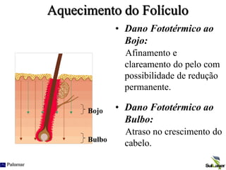 Aquecimento do Folículo
• Dano Fototérmico ao
Bojo:
Afinamento e
clareamento do pelo com
possibilidade de redução
permanente.
• Dano Fototérmico ao
Bulbo:
Atraso no crescimento do
cabelo.
Bojo
Bulbo
 