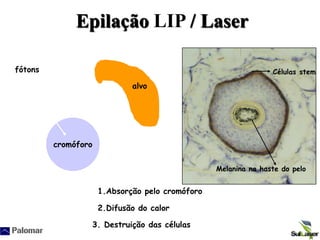 Epilação LIP / Laser
cromóforo
2.Difusão do calor
1.Absorção pelo cromóforo
fótons
3. Destruição das células
Células stem
alvo
Melanina na haste do pelo
 