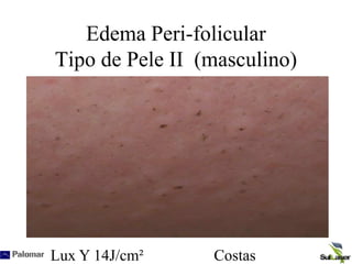 Edema Peri-folicular
Tipo de Pele II (masculino)
Lux Y 14J/cm² Costas
 