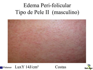 Edema Peri-folicular
Tipo de Pele II (masculino)
LuxY 14J/cm² Costas
 