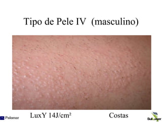 Tipo de Pele IV (masculino)
LuxY 14J/cm² Costas
 