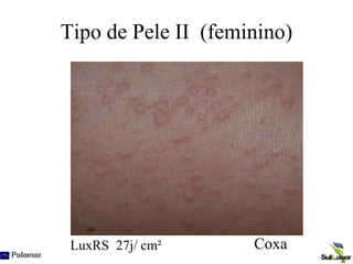 Tipo de Pele II (feminino)
LuxRS 27j/ cm² Coxa
 