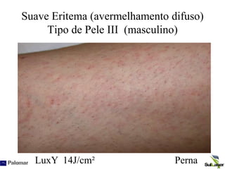Suave Eritema (avermelhamento difuso)
Tipo de Pele III (masculino)
LuxY 14J/cm² Perna
 
