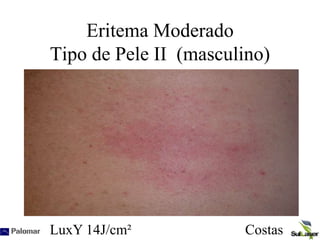 Eritema Moderado
Tipo de Pele II (masculino)
LuxY 14J/cm² Costas
 
