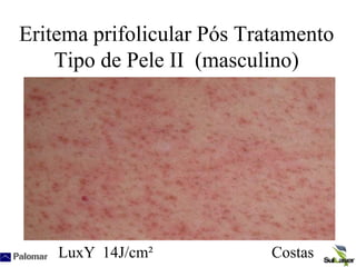 Eritema prifolicular Pós Tratamento
Tipo de Pele II (masculino)
LuxY 14J/cm² Costas
 