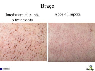 Braço
Imediatamente após
o tratamento
Após a limpeza
 