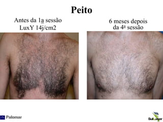 Peito
Antes da 1a sessão
LuxY 14j/cm2
6 meses depois
da 4a sessão
 