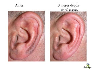 Antes 3 meses depois
da 5ª sessão
 
