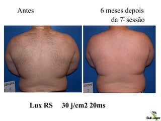 Antes 6 meses depois
da 7ª sessão
Lux RS 30 j/cm2 20ms
 