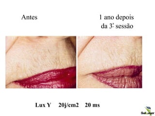 Antes 1 ano depois
da 3ª sessão
Lux Y 20j/cm2 20 ms
 