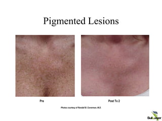 Pigmented Lesions
Pre
Photos courtesy of Randall B. Coverman, M.D.
Post Tx 2
CONFIDENTIAL Palomar Medical Technologies, Inc.
 