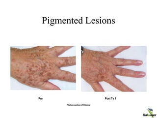 Pigmented Lesions
Pre
Photos courtesy of Palomar
Post Tx 1
CONFIDENTIAL Palomar Medical Technologies, Inc.
 