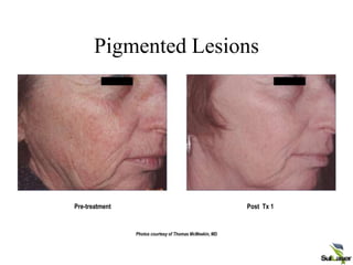 Pre-treatment Post Tx 1
Photos courtesy of Thomas McMeekin, MD
Pigmented Lesions
CONFIDENTIAL Palomar Medical Technologies, Inc.
 