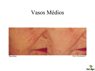 Vasos Médios
 
