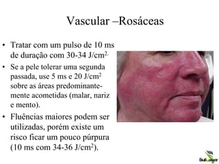 Vascular –Rosáceas
• Tratar com um pulso de 10 ms
de duração com 30-34 J/cm2.
• Se a pele tolerar uma segunda
passada, use 5 ms e 20 J/cm2
sobre as áreas predominante-
mente acometidas (malar, nariz
e mento).
• Fluências maiores podem ser
utilizadas, porém existe um
risco ficar um pouco púrpura
(10 ms com 34-36 J/cm2).
 