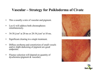 Vascular – Strategy for Poikloderma of Civate
• This a usually a mix of vascular and pigment.
• Lux G will address both chromophores
simultaneously.
• 34-38 j/cm2 at 20 ms or 28-34 j/cm2 at 10 ms.
• Significant clearing in a single treatment.
• Diffuse erythema and constriction of small vessels
and/or slight darkening of pigment are good
endpoints.
• Fluence selection will depend on quantity of
dyschromia (pigment & vascular).
 