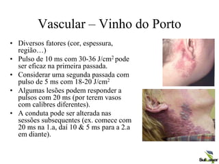 Vascular – Vinho do Porto
• Diversos fatores (cor, espessura,
região…)
• Pulso de 10 ms com 30-36 J/cm2 pode
ser eficaz na primeira passada.
• Considerar uma segunda passada com
pulso de 5 ms com 18-20 J/cm2
• Algumas lesões podem responder a
pulsos com 20 ms (por terem vasos
com calibres diferentes).
• A conduta pode ser alterada nas
sessões subsequentes (ex. comece com
20 ms na 1.a, daí 10 & 5 ms para a 2.a
em diante).
 