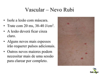 Vascular – Nevo Rubi
• Isole a lesão com máscara.
• Trate com 20 ms, 38-40 J/cm2.
• A lesão deverá ficar cinza
claro.
• Alguns nevos mais espessos
irão requerer pulsos adicionais.
• Outros nevos maiores podem
necessitar mais de uma sessão
para clarear por completo.
 