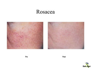 Rosacea
Pre Post
CONFIDENTIAL Palomar Medical Technologies, Inc.
 