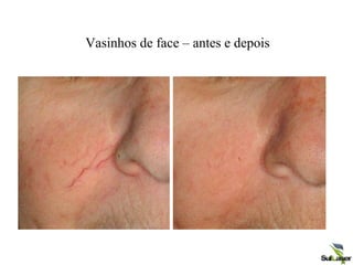 Vasinhos de face – antes e depois
 