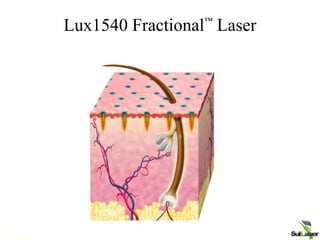 Lux1540 Fractional™
Laser
 