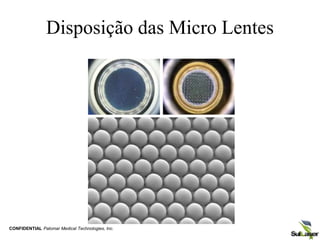 Disposição das Micro Lentes
CONFIDENTIAL Palomar Medical Technologies, Inc.
 