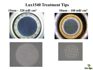 10mm - 100 mB/ cm2
15mm - 320 mB/ cm2
Lux1540 Treatment Tips
 