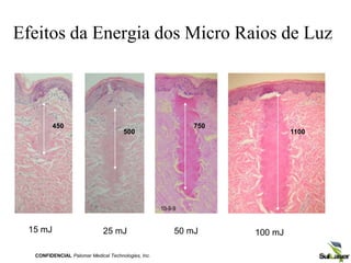 15 mJ 25 mJ 50 mJ
450
500
Efeitos da Energia dos Micro Raios de Luz
CONFIDENCIAL Palomar Medical Technologies, Inc.
100 mJ
750
1100
 