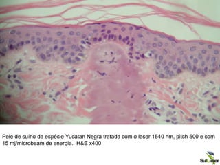 Pele de suíno da espécie Yucatan Negra tratada com o laser 1540 nm, pitch 500 e com
15 mj/microbeam de energia. H&E x400
 