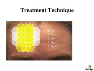 Treatment Technique
1. Pass
2. Pass
3. Pass
4. Pass
5. Pass
 
