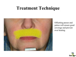 Offsetting passes and
pulses will ensure good
coverage and prevent
over heating.
Treatment Technique
 